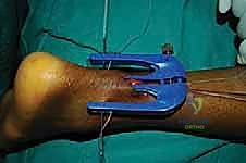 خياطة الجلد التجميلية