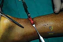 صورة توضيحية لـ إصلاح وتر أخيل بالحد الأدنى للتدخل الجراحي: دليل شامل للمرضى