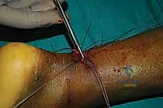 تمرير الخيوط في الجزء السفلي