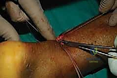 ربط الخيوط وضبط الشد