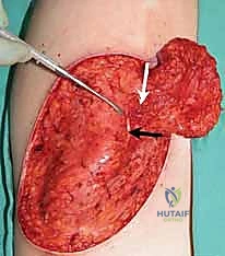 Upper Extremity Burn & Contracture Reconstruction: An Intraoperative Masterclass