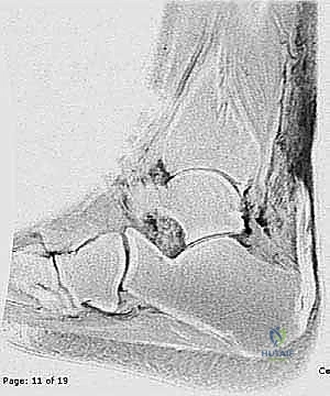 صورة توضيحية لـ إصلاح وتر العرقوب بالحد الأدنى من التدخل الجراحي: دليلك الشامل للتعافي مع الأستاذ الدكتور محمد هطيف