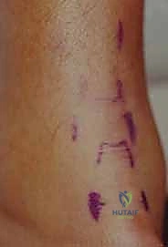 خيارات العلاج لوتر العرقوب