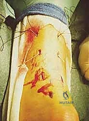 مقارنة بين الجراحة المفتوحة والمغلقة