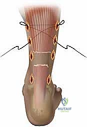 خطوات الجراحة الدقيقة
