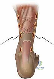 صورة توضيحية لـ إصلاح وتر العرقوب بالحد الأدنى من التدخل الجراحي: دليلك الشامل للتعافي مع الأستاذ الدكتور محمد هطيف