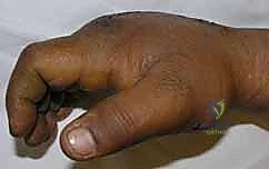 علاج تقلصات مفاصل اليد (MCP و PIP): استعادة مرونة أصابعك مع الأستاذ الدكتور محمد هطيف في صنعاء