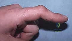 خطوات الجراحة الميكروسكوبية لتحرير مفاصل اليد