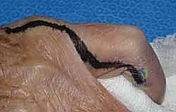 تحرير الأربطة المتليفة في مفاصل الأصابع