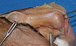 صورة توضيحية لـ علاج تقلصات مفاصل اليد (MCP و PIP): استعادة مرونة أصابعك مع الأستاذ الدكتور محمد هطيف في صنعاء