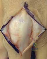 التحرير التدريجي للأنسجة واختبار الحركة