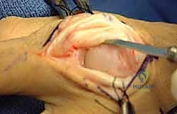 التقييم الفوري لمرونة المفصل أثناء الجراحة