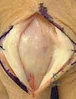 عمل الشق الجراحي بدقة لتجنب الندبات المعيقة