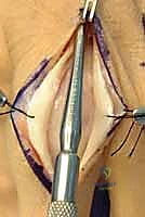 التشريح الدقيق لمفاصل اليد السنعية السلامية