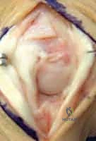 قياس المدى الحركي المفقود في مفاصل الأصابع