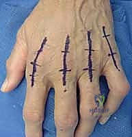 بدء التمارين الحركية الخفيفة بعد الجراحة مباشرة