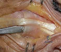 تمارين تقوية قبضة اليد في مرحلة التأهيل المتقدمة