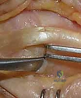 استخدام الجبائر الديناميكية في علاج تيبس الأصابع