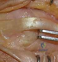 صورة توضح نجاح استعادة القدرة على الإمساك بالأشياء