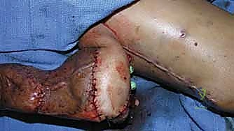 إغلاق الجرح بغرز تجميلية دقيقة