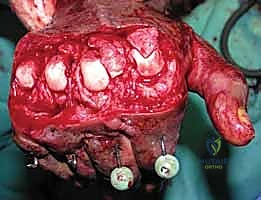 صورة توضيحية لـ علاج تقلصات مفاصل اليد (MCP و PIP): استعادة مرونة أصابعك مع الأستاذ الدكتور محمد هطيف في صنعاء