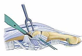 الأستاذ الدكتور محمد هطيف أثناء إجراء جراحة دقيقة لليد