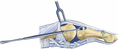 استخدام التكبير الجراحي لحماية الأعصاب والأوعية