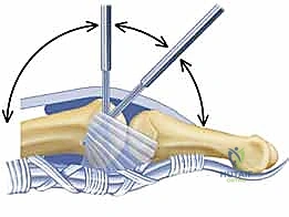 صورة توضيحية لـ علاج تقلصات مفاصل اليد (MCP و PIP): استعادة مرونة أصابعك مع الأستاذ الدكتور محمد هطيف في صنعاء