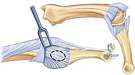 مقارنة النتائج قبل وبعد تحرير مفصل PIP