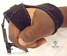 استخدام التقنيات الحديثة في تشخيص تقلصات اليد