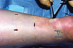 خطوات إجراء جراحة إصلاح وتر أخيل بالتدخل المحدود