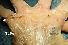 تأثير مرض دوبويتران على أوتار اليد والأعصاب