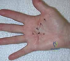 التشريح الدقيق لراحة اليد وتليف دوبويتران