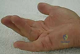 استئصال الأنسجة المتليفة بدقة متناهية تحت التكبير