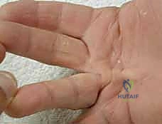 التخطيط الجراحي لاستئصال اللفافة المتليفة بدقة