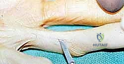 إغلاق الجرح بتقنية Z-plasty التجميلية لمنع الانكماش المستقبلي