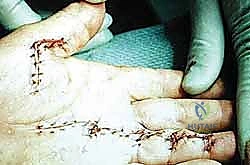 حماية الأعصاب والأوعية الدموية أثناء الجراحة الميكروسكوبية