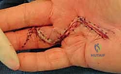 مراحل تطور انكماش الأصابع في مرض دوبويتران