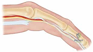العوامل الوراثية المسببة لانكماش دوبويتران وتأثيرها