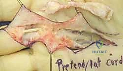 اختبار الطاولة لتشخيص تليف دوبويتران