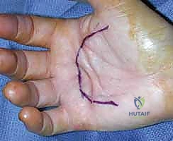 الخيارات العلاجية غير الجراحية لمرض دوبويتران