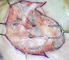 جلسات العلاج الطبيعي لاستعادة حركة الأصابع بالكامل