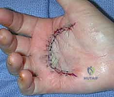 صورة توضيحية لـ عملية استئصال تليف دوبويتران: استعادة مرونة اليد ووظيفتها مع الأستاذ الدكتور محمد هطيف في صنعاء