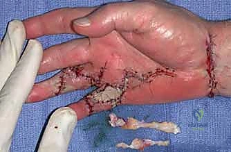 تركيب الجبيرة المخصصة بعد جراحة دوبويتران للحفاظ على النتيجة