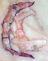 مريض يستعيد قدرته على استخدام يده بشكل طبيعي بعد الجراحة