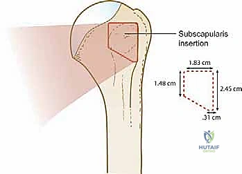 صورة توضيحية لـ إصلاح وتر تحت الكتف بالمنظار في صنعاء: دليل شامل من الأستاذ الدكتور محمد هطيف