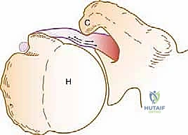 صورة توضيحية لـ إصلاح وتر تحت الكتف بالمنظار في صنعاء: دليل شامل من الأستاذ الدكتور محمد هطيف