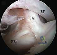 صورة طبية: إصلاح وتر تحت الكتف بالمنظار في صنعاء: دليل شامل من الأستاذ الدكتور محمد هطيف