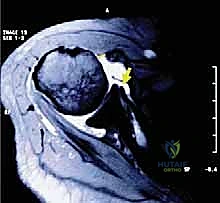 صورة طبية: إصلاح وتر تحت الكتف بالمنظار في صنعاء: دليل شامل من الأستاذ الدكتور محمد هطيف