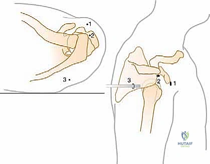 صورة طبية: إصلاح وتر تحت الكتف بالمنظار في صنعاء: دليل شامل من الأستاذ الدكتور محمد هطيف